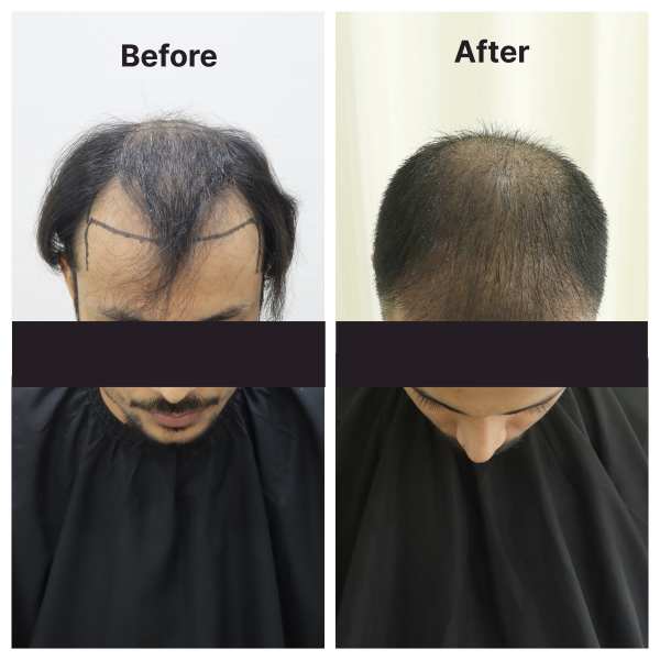 Hair Transplant result KOQ10